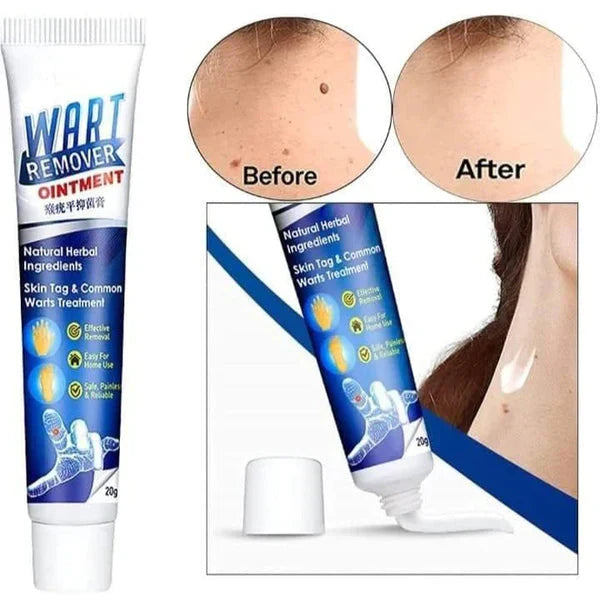 Wart Remover Cream